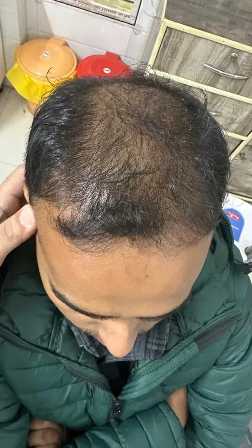 Before Hair Transplant